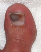 purple_toe